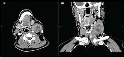 Neoadjuvant treatment with lenvatinib and pembrolizumab in a BRAF V600E-mutated anaplastic thyroid cancer: a case report